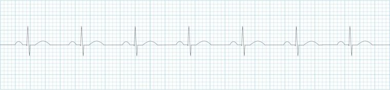 sinus-rhythm-strip